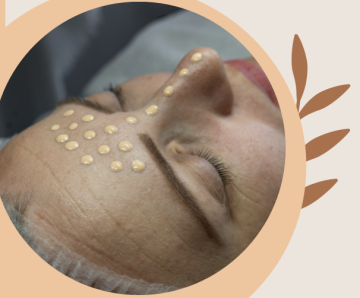 MicroNeedling – BB Glow