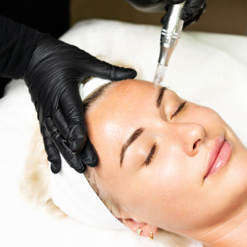 MicroNeedling – BB Glow - Mina Le Berlin Lichtenberg